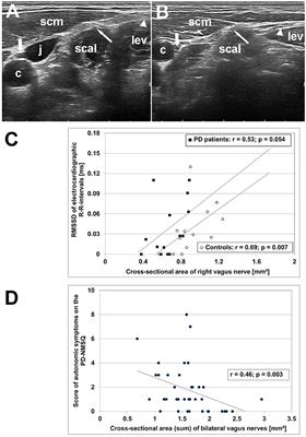 Atrophy of the Vagus Nerve in Parkinson's Disease Revealed by High-Resolution Ultrasonography